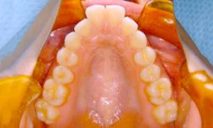 歯のイメージ画像