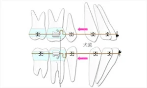 歯を大きく移動できる