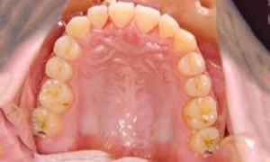 歯のイメージ画像